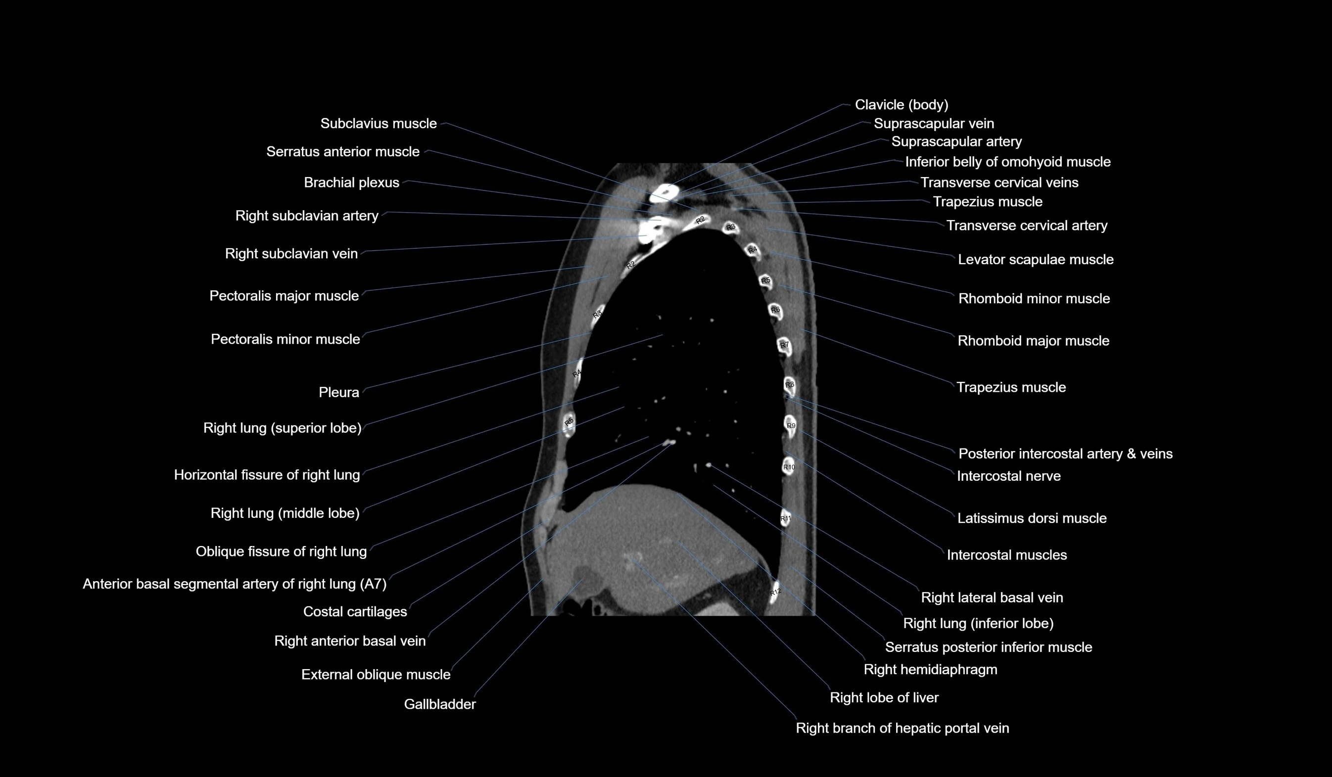 CT chest (thorax) labelled sagittal cross sectional anatomy radiology image-00041.webp
